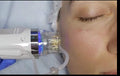 PRP Microneedling